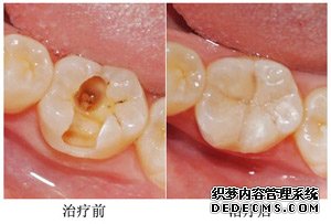 爱齿尔治疗儿童虫牙